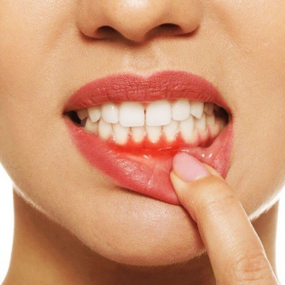 آبسه دندان چیست؟ علل، علائم و راه‌های کنترل آبسه لثه